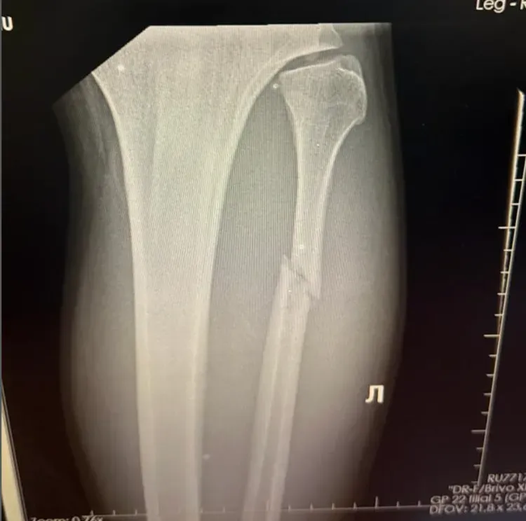 Valter Walker confirme sa blessure : le péroné est fissuré mais l'opération n'est pas nécessaire pour le moment