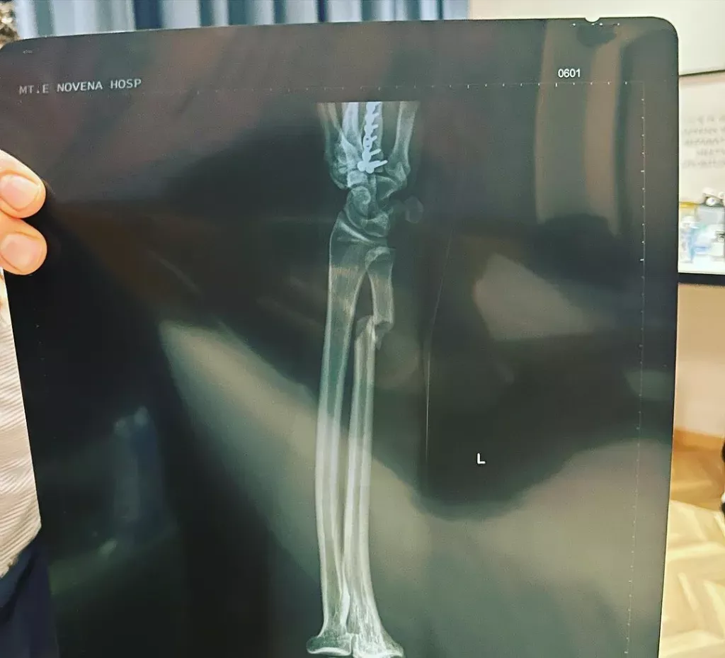 Alex Caceres partage une radiographie de son avant-bras cassé | UFC on ESPN+ 83