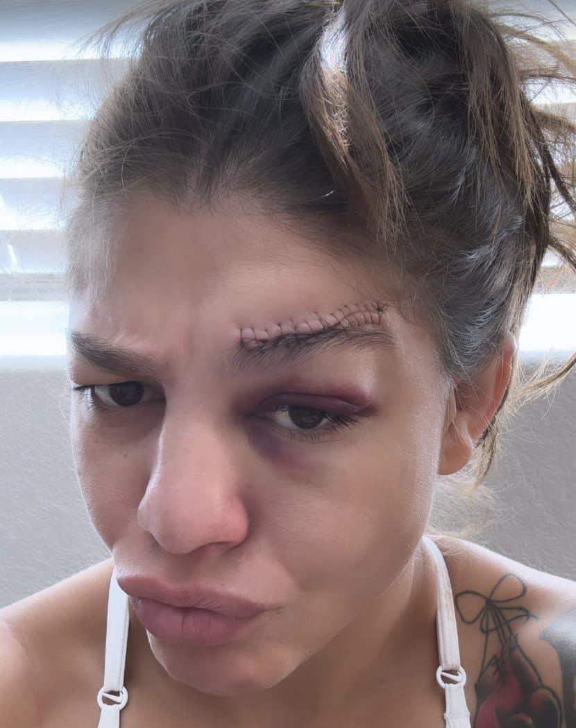 Mayra Bueno Silva publie une image de sa blessure | UFC 303